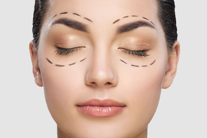 blefaroplastia