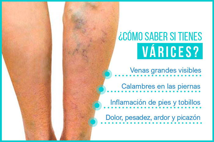 varices