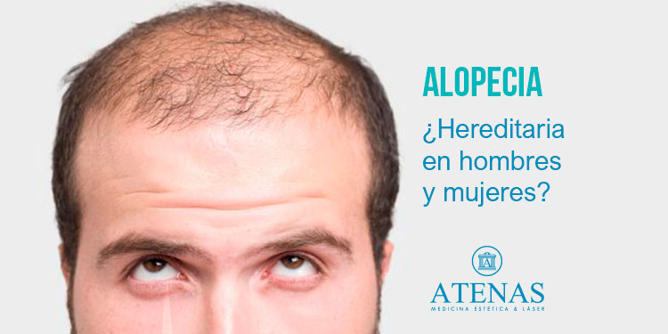 ALOPECIA: Pérdida de cabello