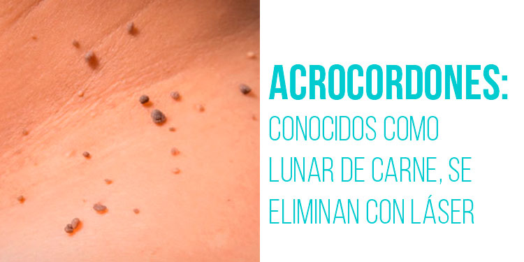 ACROCORDONES: lunares de piel