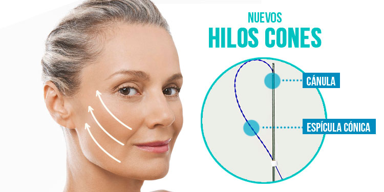 HILOS CONES: Resultados inmediatos con efecto prolongado